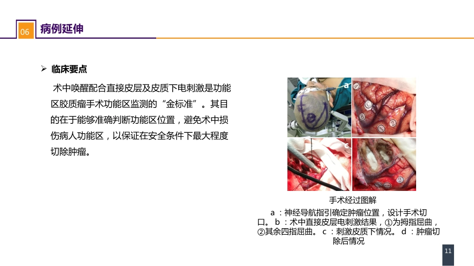 外科学：案例分析-大脑胶质瘤_第11页