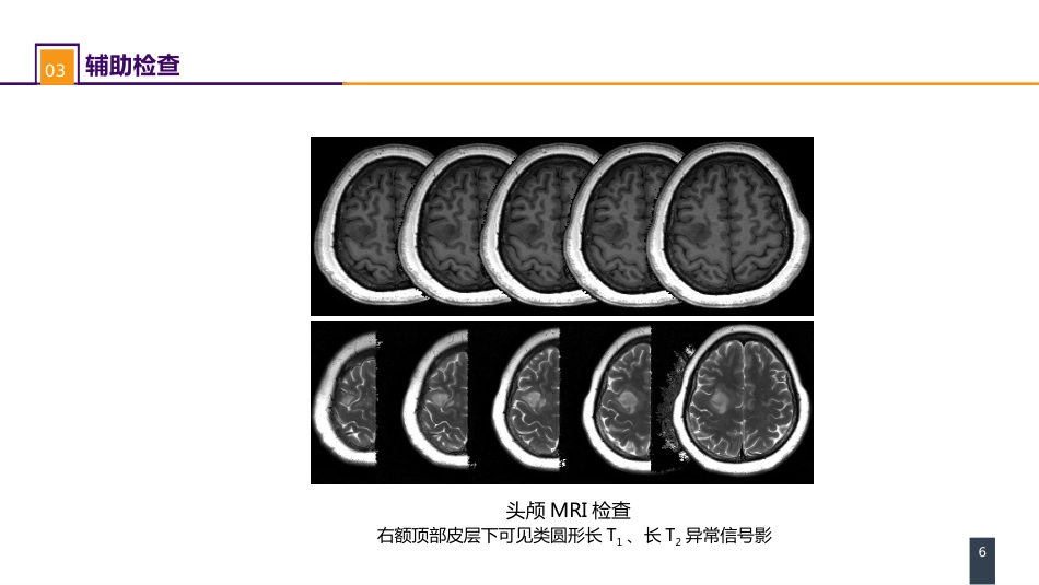 外科学：案例分析-大脑胶质瘤_第6页