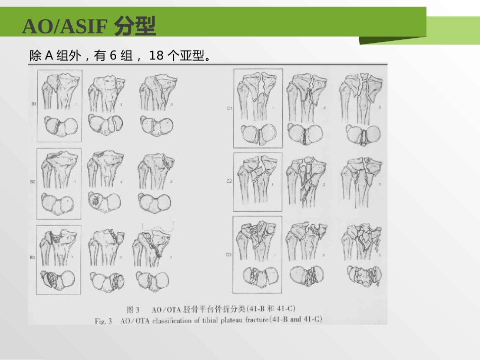外科学：胫骨平台骨折分型_第11页