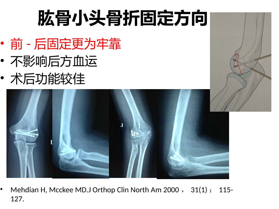 外科学：肱骨小头骨折的手术技巧_第13页