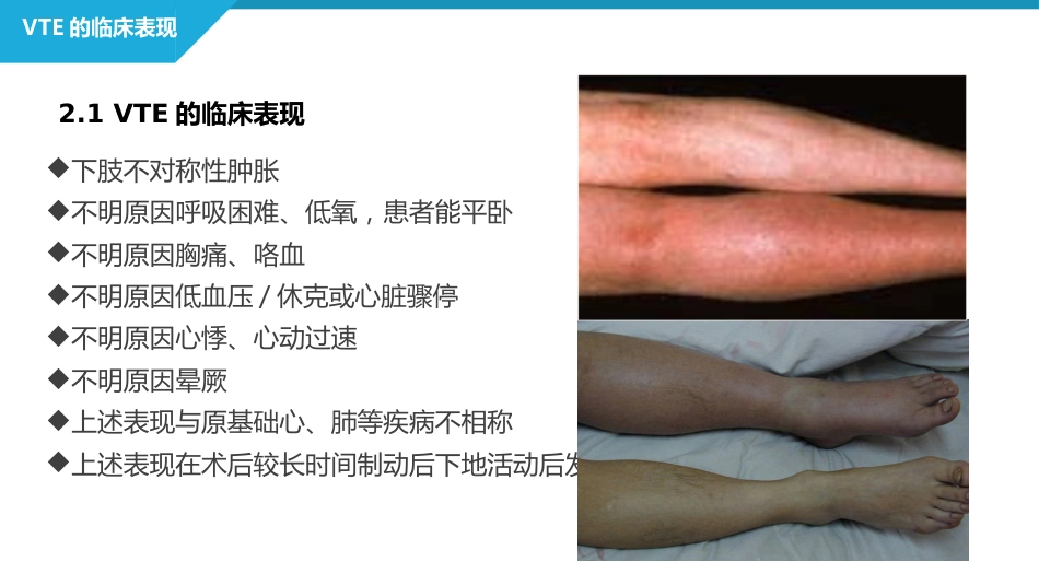 静脉血栓栓塞症（VTE）的诊断和治疗_第11页