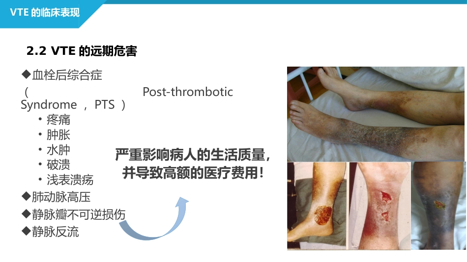 静脉血栓栓塞症（VTE）的诊断和治疗_第12页