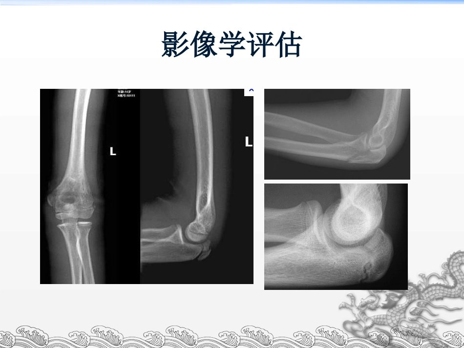 外科学：尺骨鹰嘴骨折_第10页