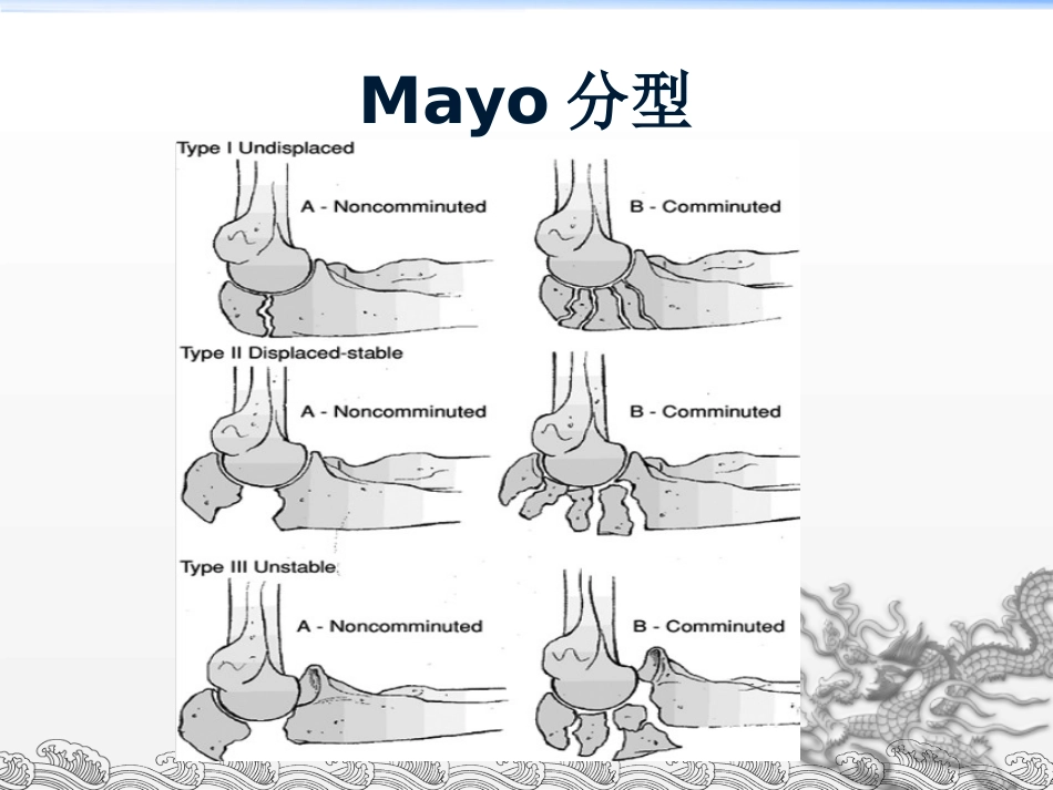 外科学：尺骨鹰嘴骨折_第13页