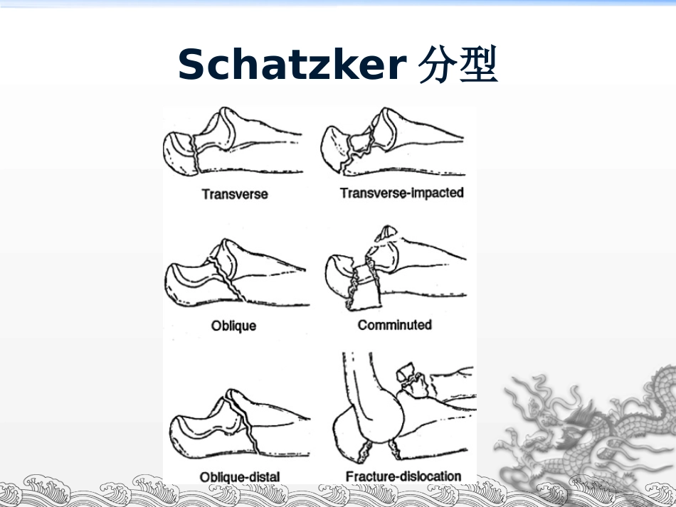 外科学：尺骨鹰嘴骨折_第15页
