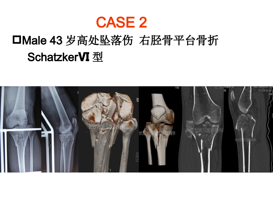 外科学：3D打印技术在骨科临床的应用_第12页