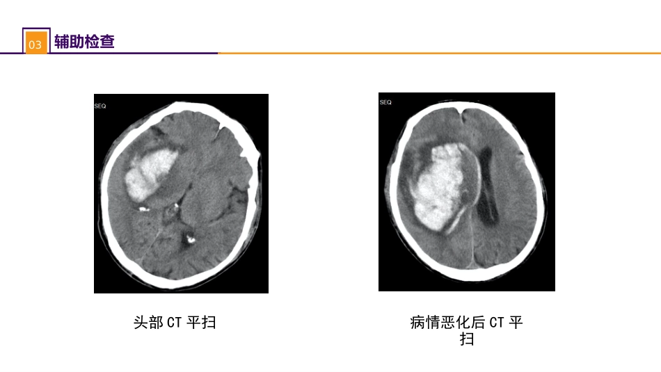 外科学：案例分析-高血压脑出血_第6页