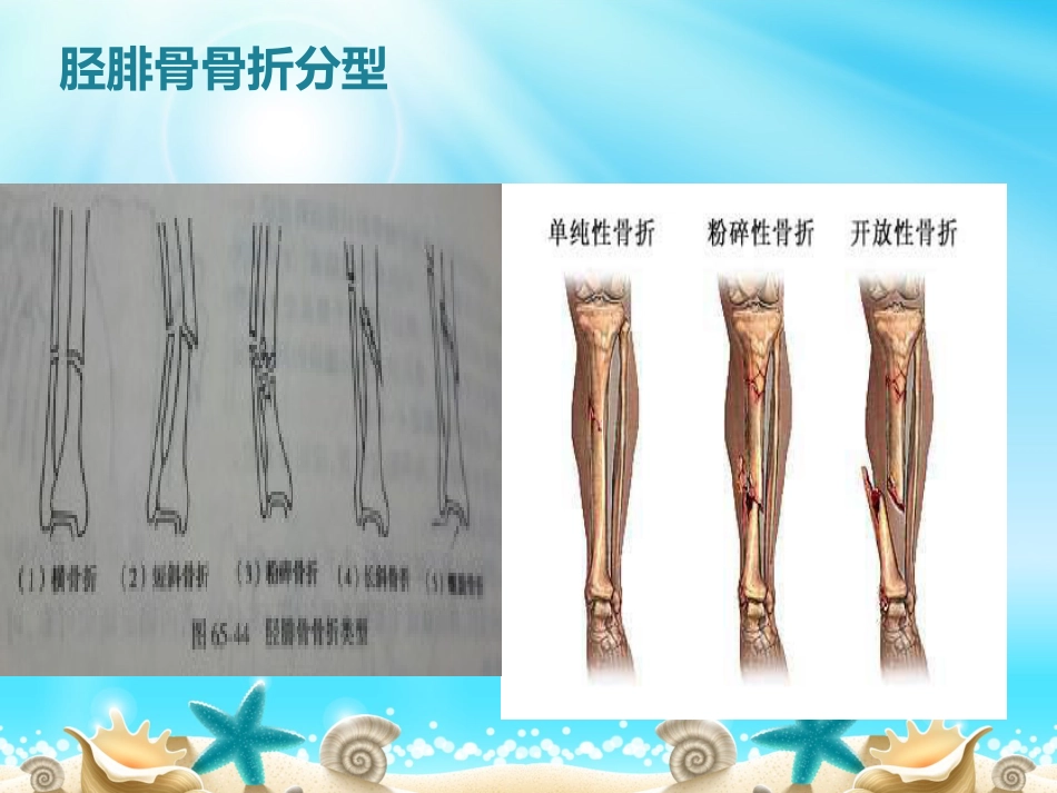 外科学：胫腓骨骨折分型_第11页