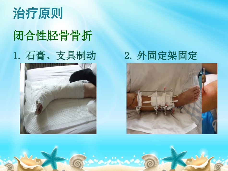 外科学：胫腓骨骨折分型_第15页