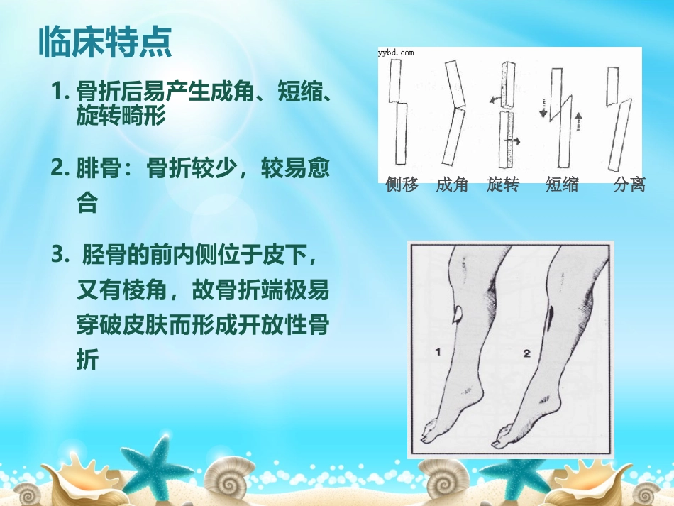 外科学：胫腓骨骨折分型_第8页