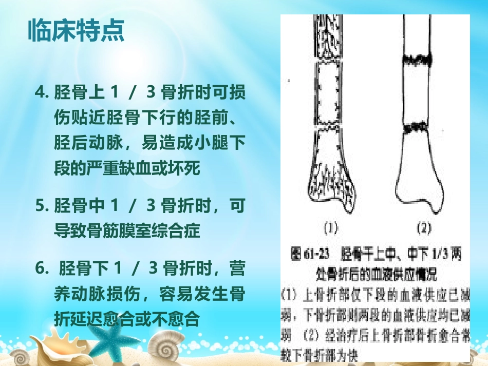 外科学：胫腓骨骨折分型_第9页