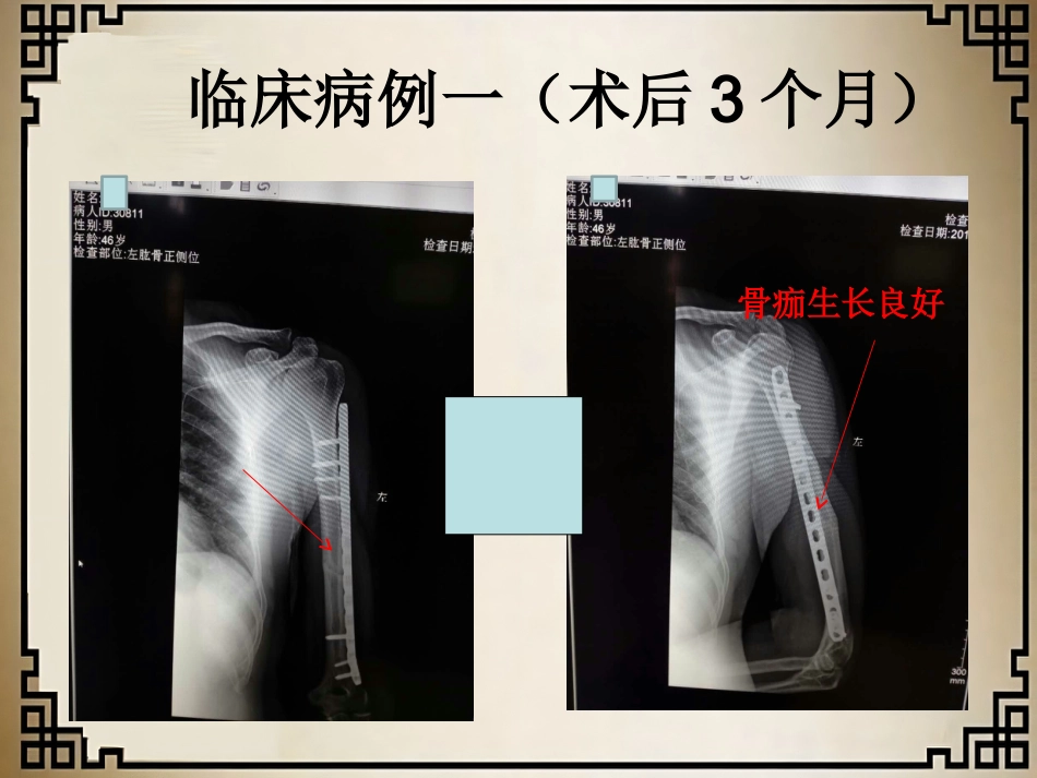 外科学：经皮微创锁定钢板治疗肱骨骨折_第10页