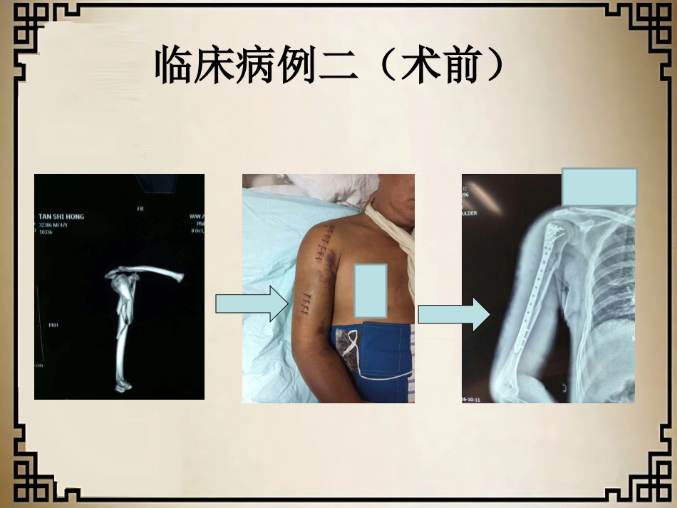 外科学：经皮微创锁定钢板治疗肱骨骨折_第11页