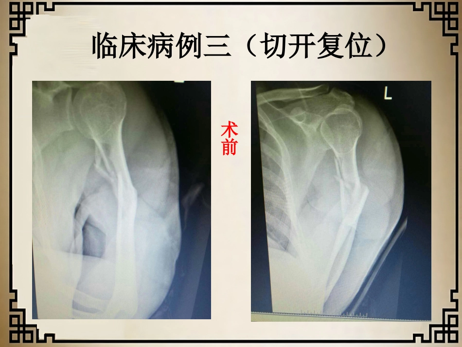 外科学：经皮微创锁定钢板治疗肱骨骨折_第12页