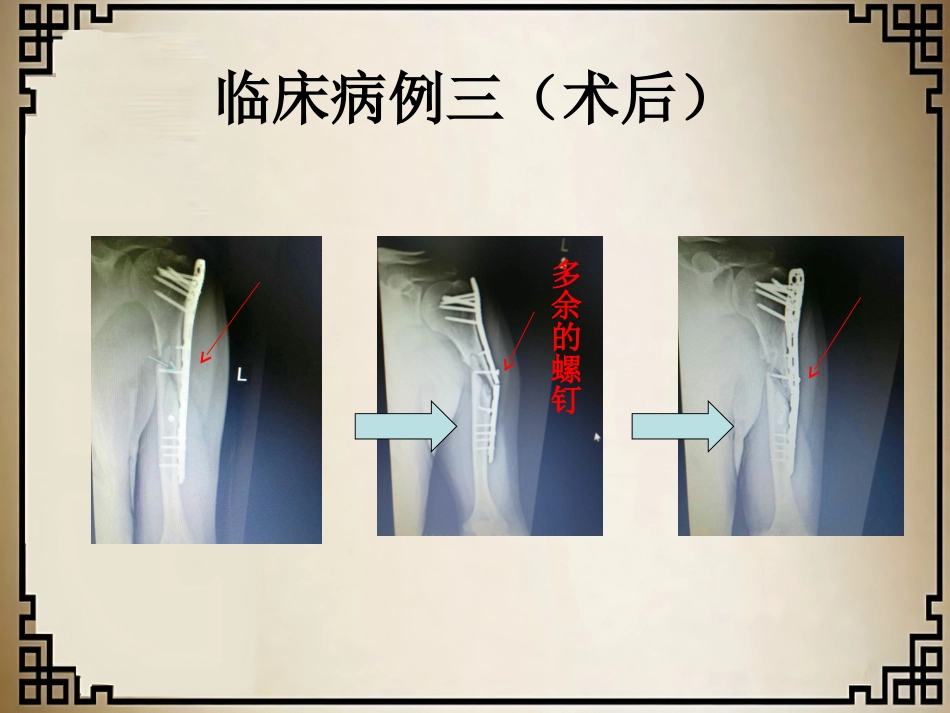 外科学：经皮微创锁定钢板治疗肱骨骨折_第13页