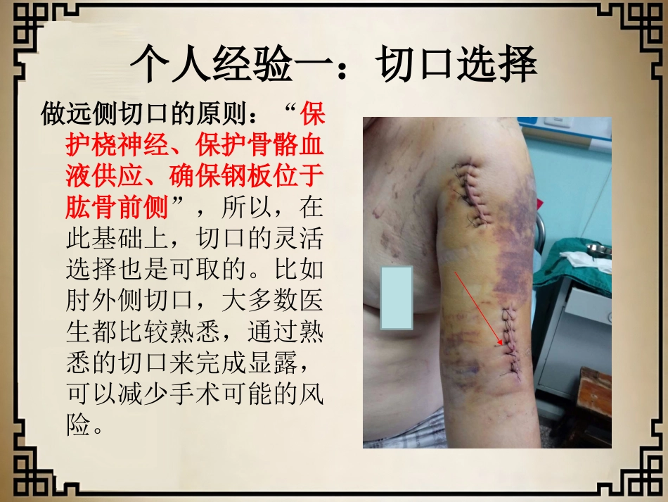 外科学：经皮微创锁定钢板治疗肱骨骨折_第15页