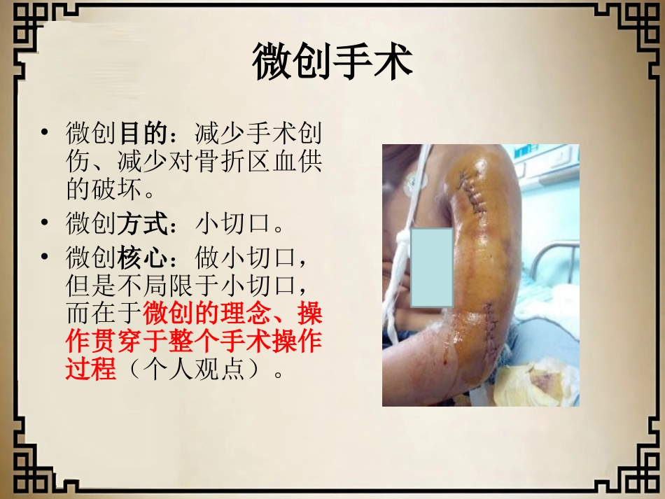 外科学：经皮微创锁定钢板治疗肱骨骨折_第2页