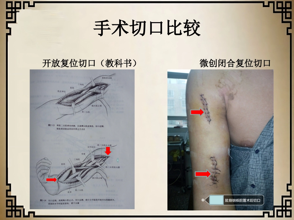 外科学：经皮微创锁定钢板治疗肱骨骨折_第3页