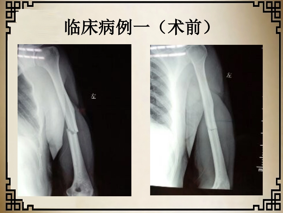 外科学：经皮微创锁定钢板治疗肱骨骨折_第8页