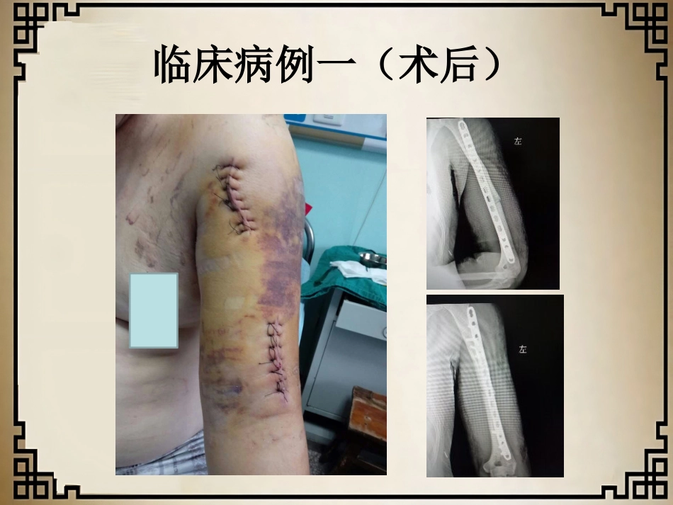 外科学：经皮微创锁定钢板治疗肱骨骨折_第9页