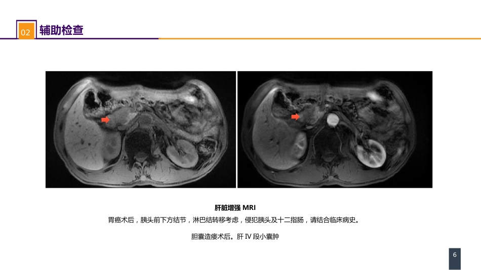外科休克： 案例分析-肝胆胰术后失血性休克一例_第6页