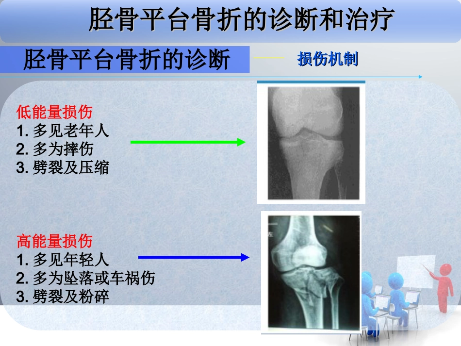 外科学：胫骨平台骨折_第14页