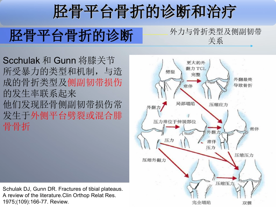 外科学：胫骨平台骨折_第15页