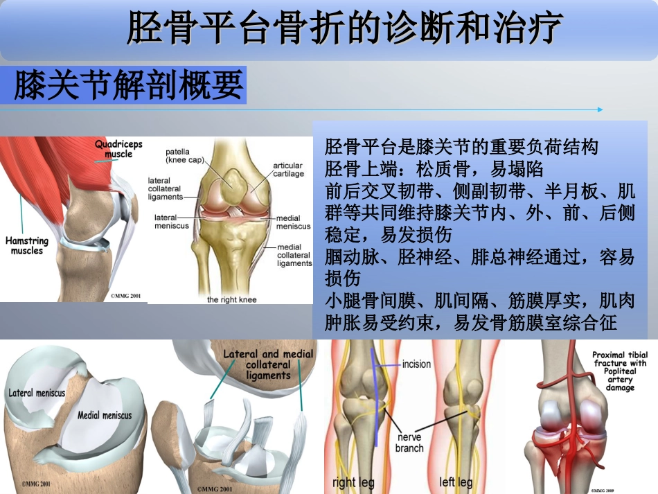 外科学：胫骨平台骨折_第6页