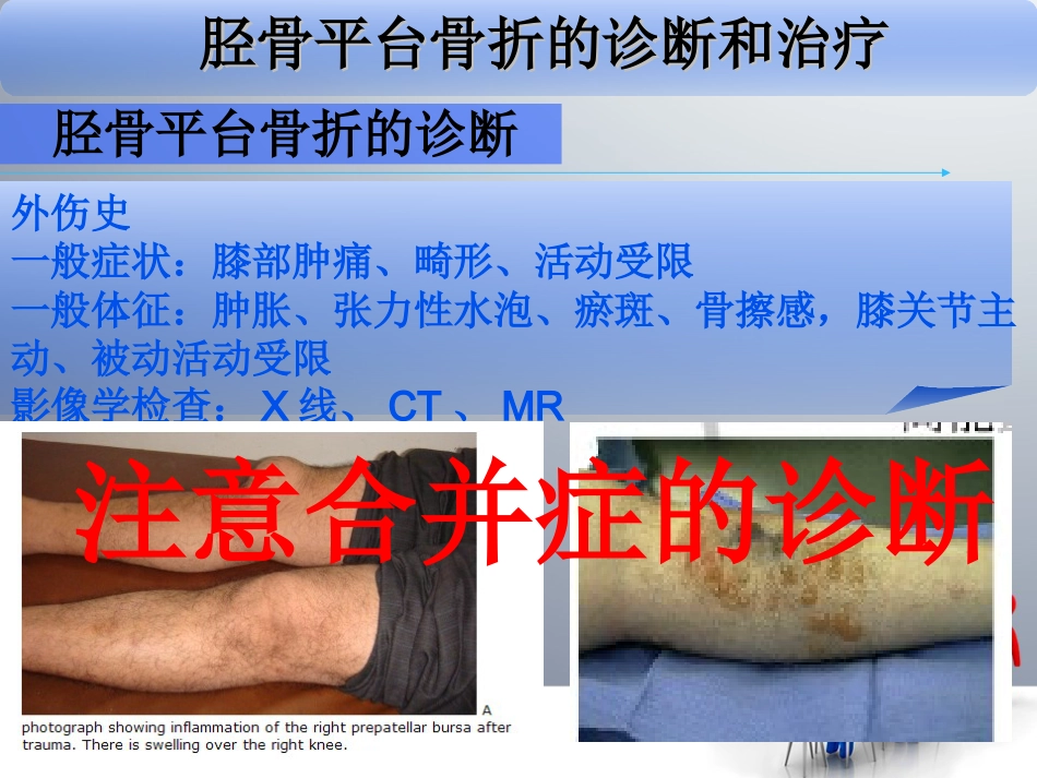 外科学：胫骨平台骨折_第8页