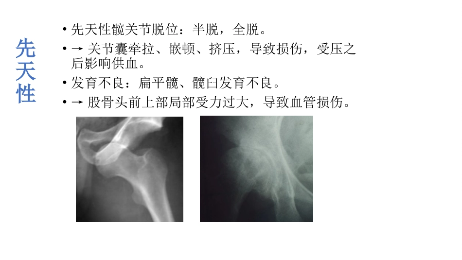 外科学：股骨头坏死_第13页
