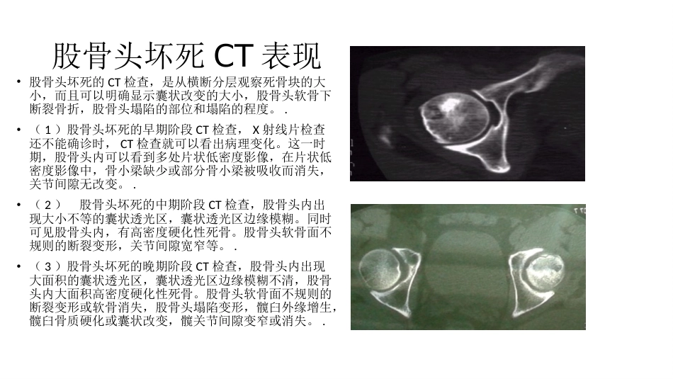 外科学：股骨头坏死_第8页