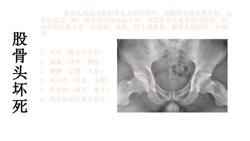 外科学：股骨头坏死