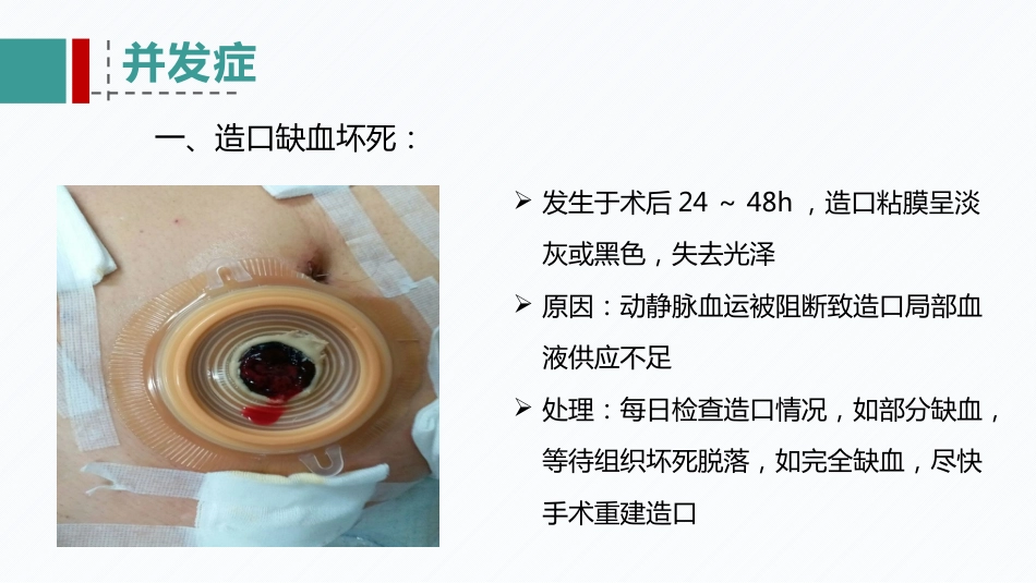 肠造口患者的病例讨论_第11页