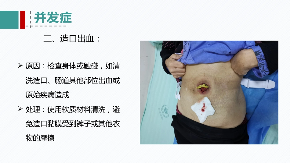 肠造口患者的病例讨论_第12页