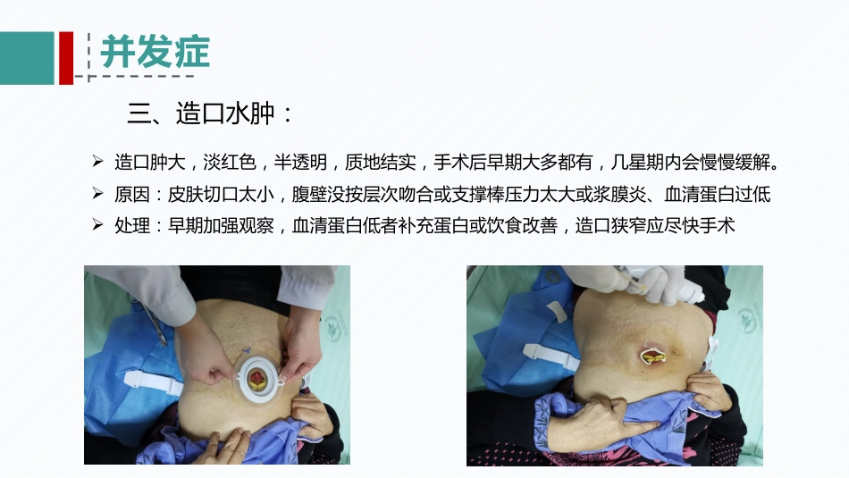 肠造口患者的病例讨论_第13页