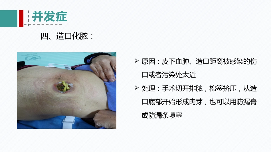 肠造口患者的病例讨论_第14页