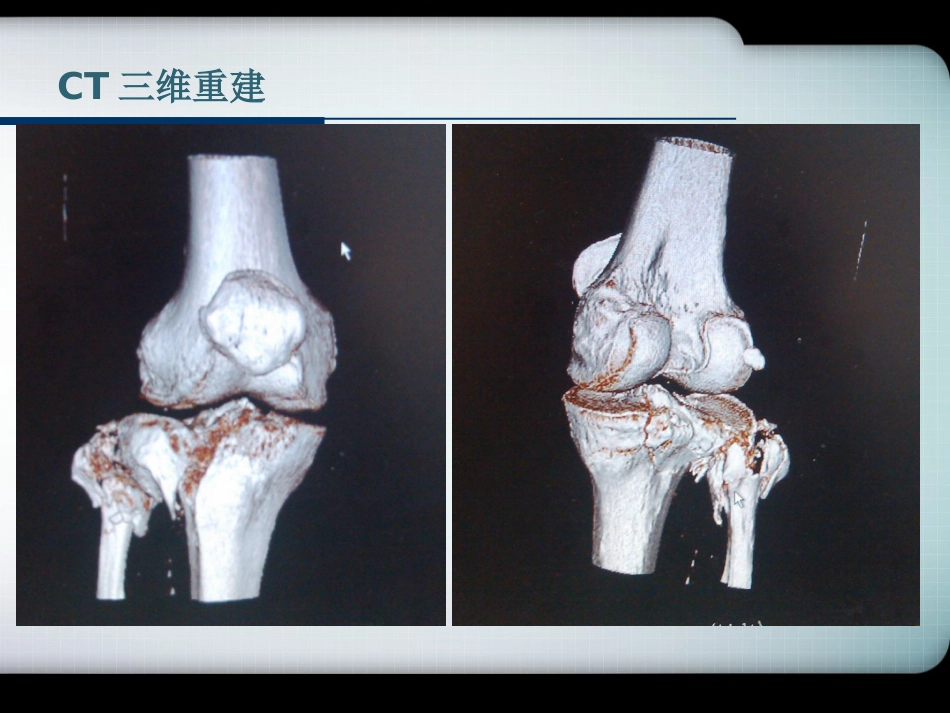 外科学：胫骨平台骨折的诊断与分型(最新)_第11页