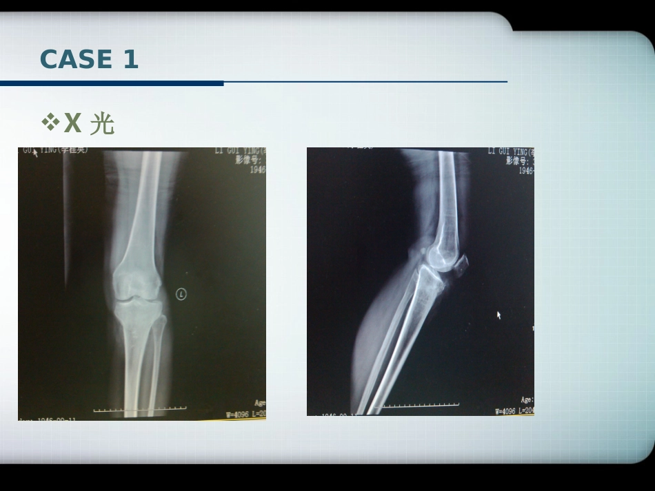 外科学：胫骨平台骨折的诊断与分型(最新)_第2页