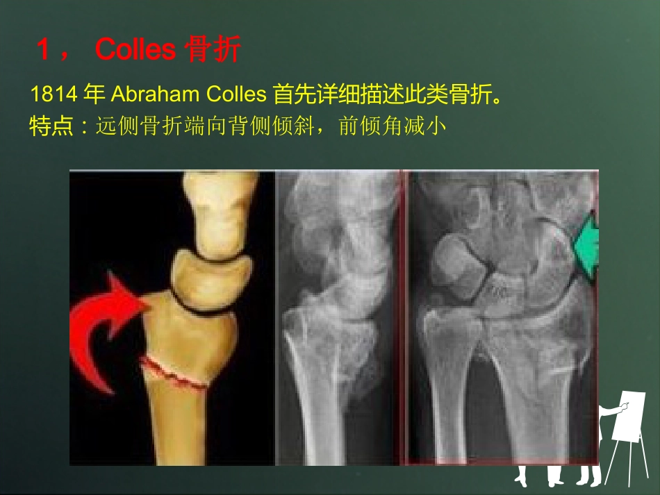 外科学：桡骨远端骨折分型_第14页