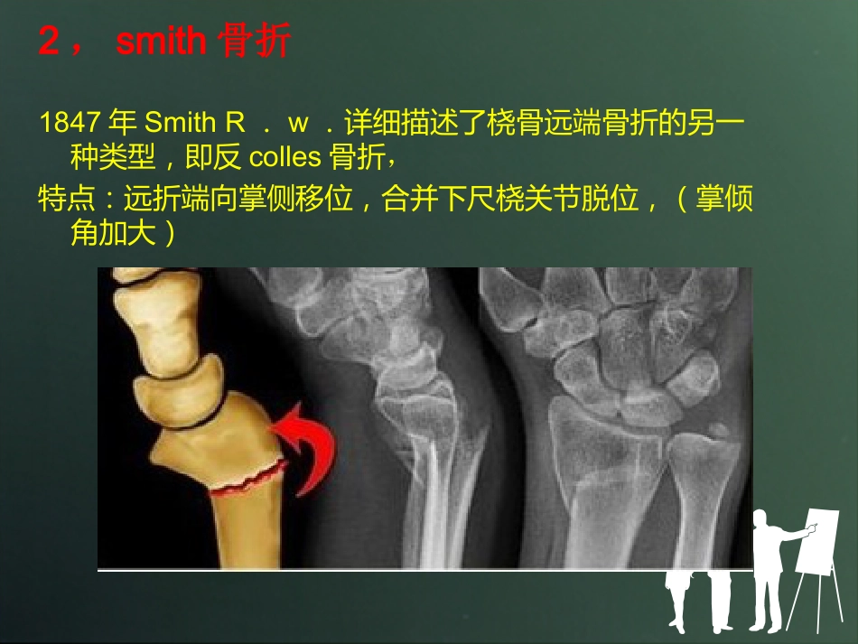 外科学：桡骨远端骨折分型_第15页