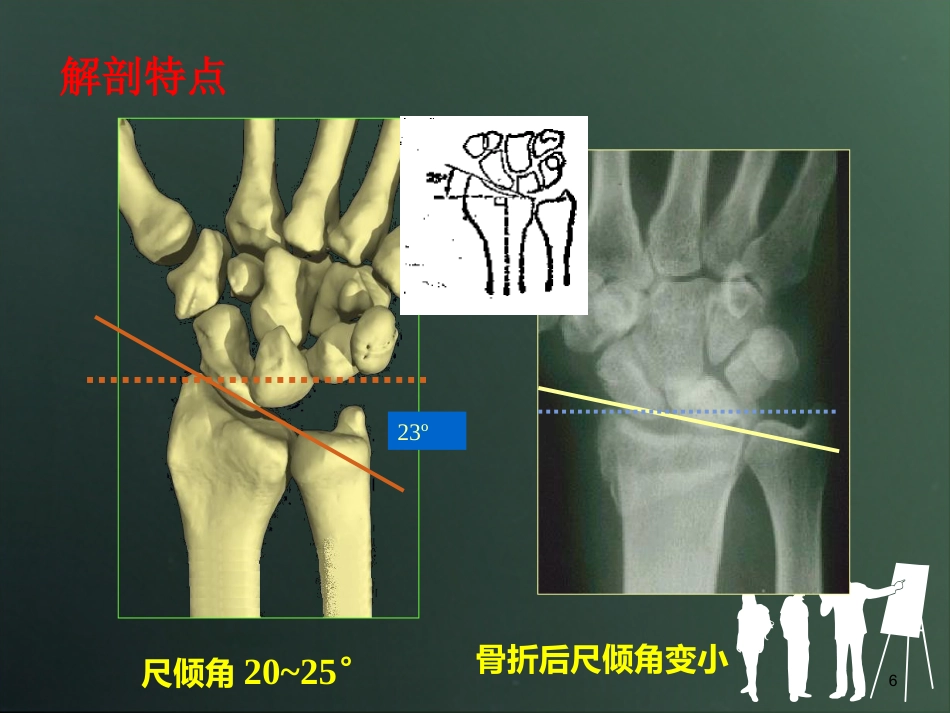 外科学：桡骨远端骨折分型_第6页