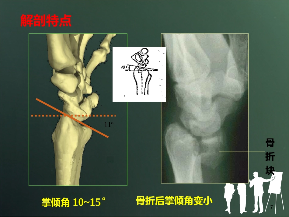 外科学：桡骨远端骨折分型_第7页