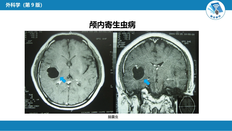 外科学：颅内压增高和脑疝_第14页