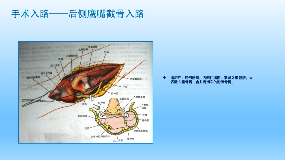 外科学：剪切型骨折的治疗_第10页