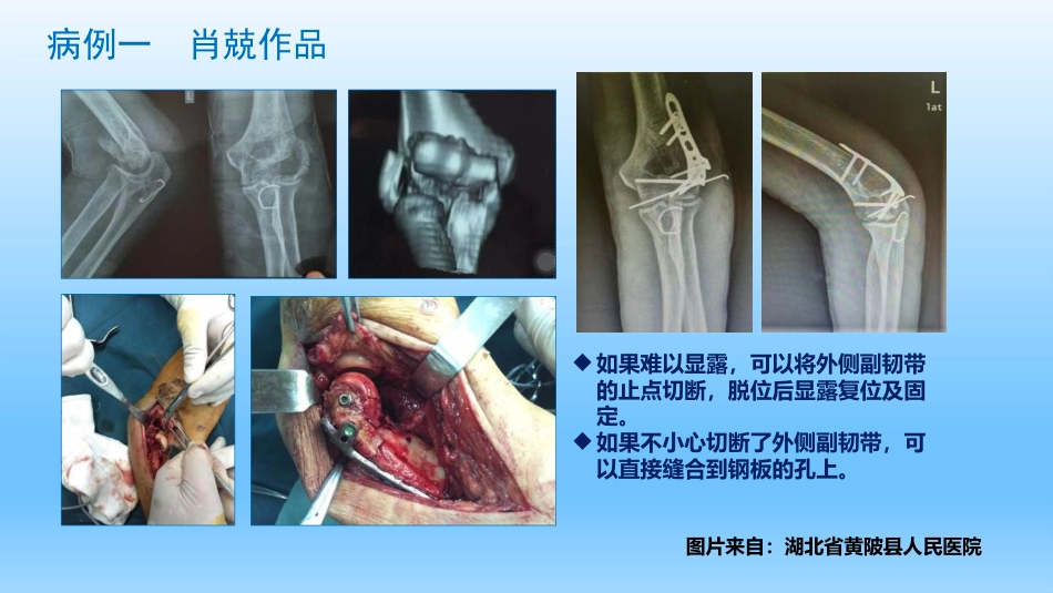 外科学：剪切型骨折的治疗_第11页