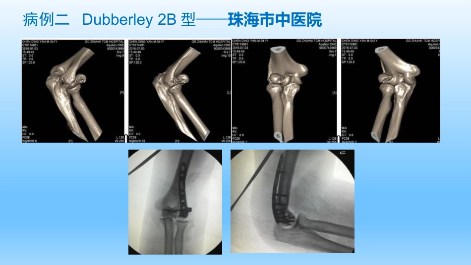 外科学：剪切型骨折的治疗_第12页