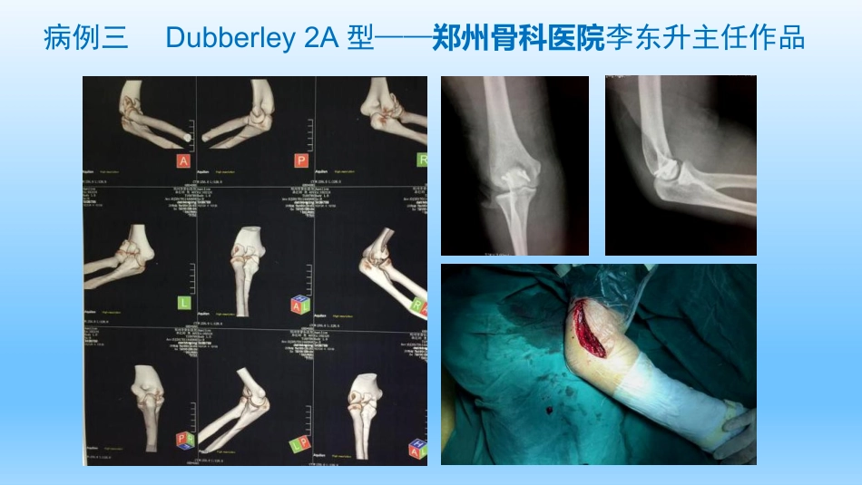 外科学：剪切型骨折的治疗_第13页