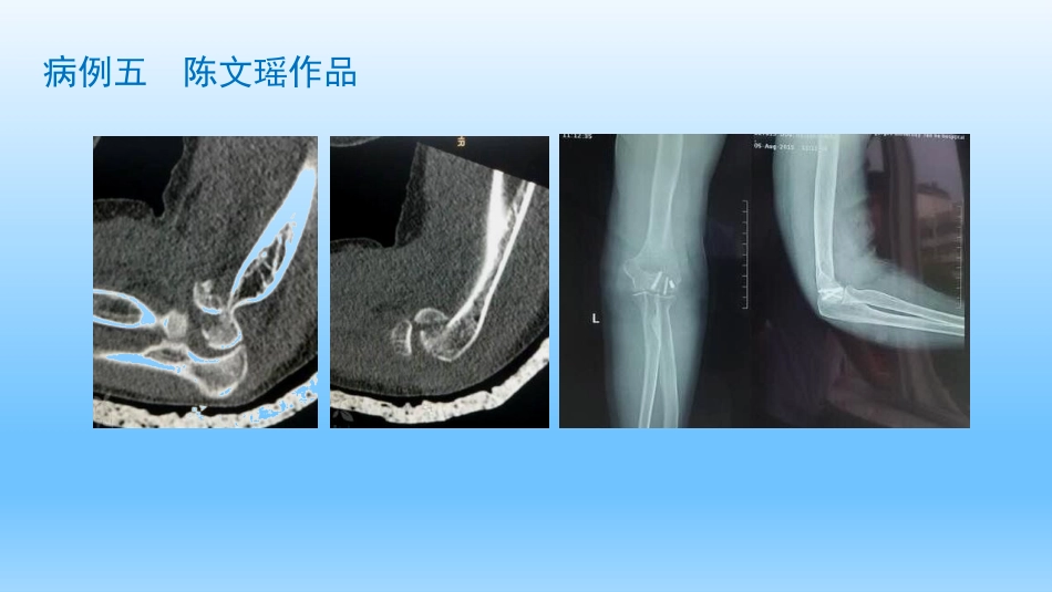 外科学：剪切型骨折的治疗_第15页