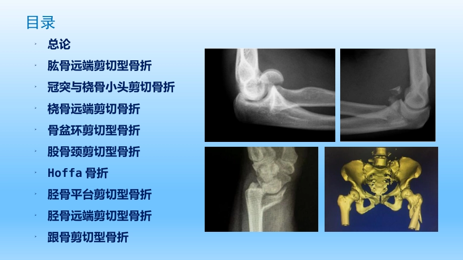 外科学：剪切型骨折的治疗_第2页