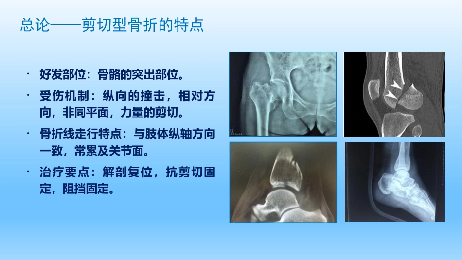 外科学：剪切型骨折的治疗_第3页